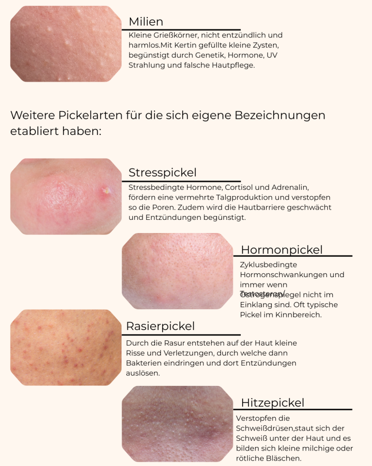 arten von akne 
