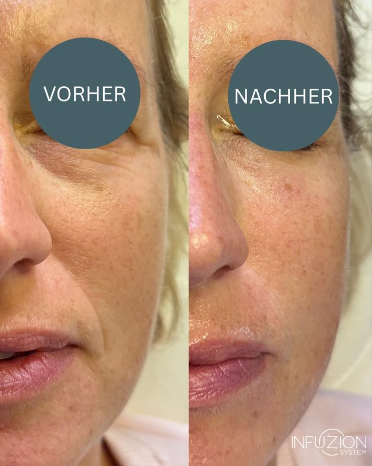 Hyaluron ohne Nadel im Kosmetikstudio Dortmund. Vorher Nachher Faltenbehandlung