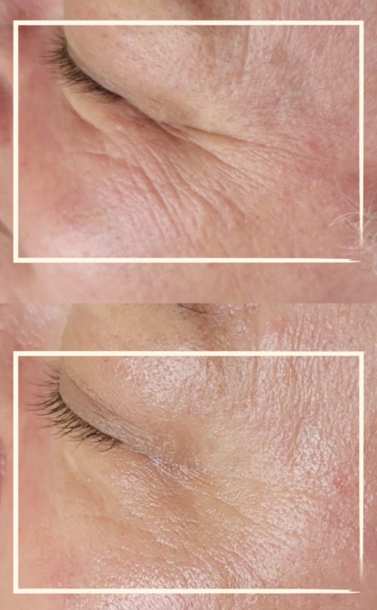 Hyaluron ohne Nadel im Kosmetikstudio Dortmund. Vorher Nachher Faltenbehandlung