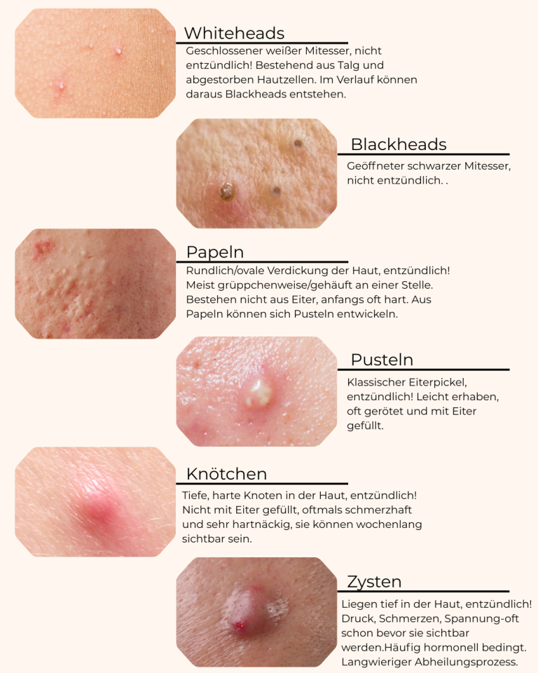 akne behandeln dortmund