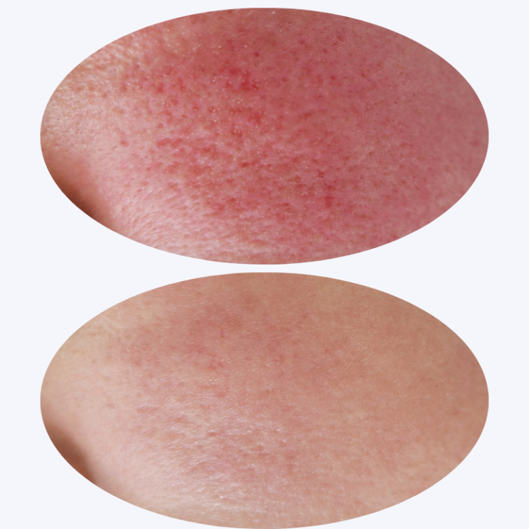 Rosazea behandeln im Kosmetikstudio Dortmund